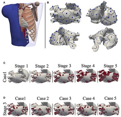 Atrial Fibrosis Hampers Non-invasive Localization of Atrial Ectopic Foci From Multi-Electrode Signals: A 3D Simulation Study